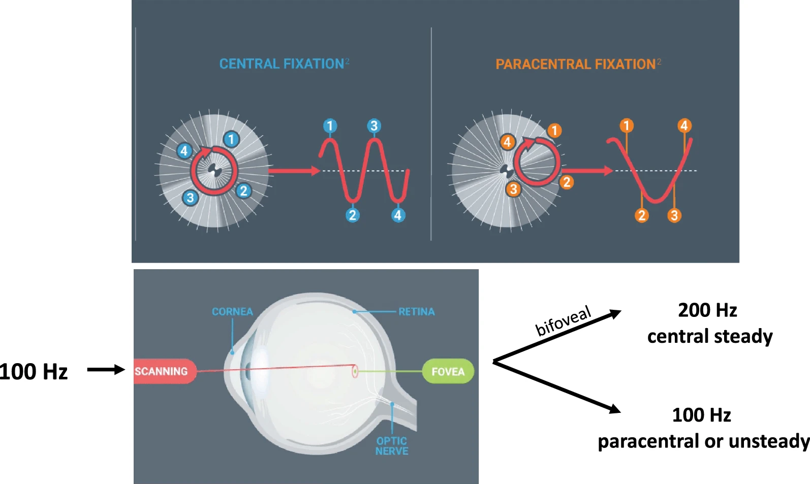 The blinq® determines if faulty fixation is present and provides direct screening of microstrabismus as small as 1° and amblyopia. (Source: https://link.springer.com/article/10.1007/s40123-021-00394-7/figures/1)