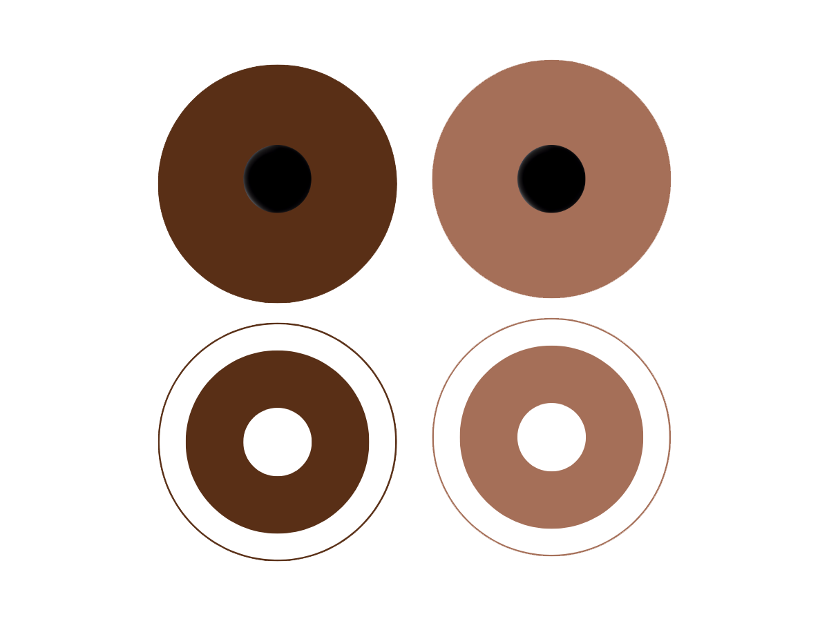 生活新视界：义眼隐形眼镜作为脑震荡后畏光的解决方案