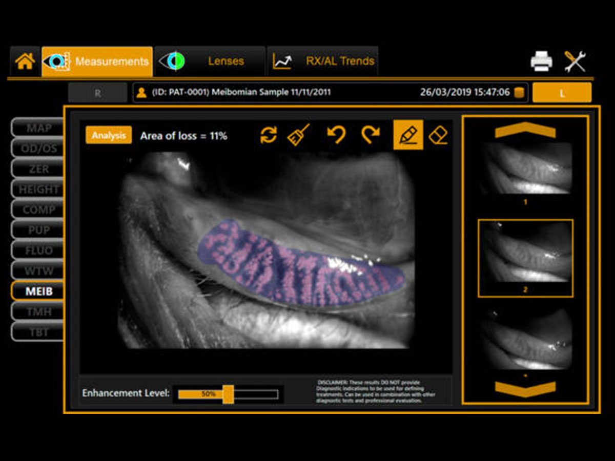 Dry eyes screening checks the amount of tears, the quality of your tears, how long they can stay on the surface of the eyes as well as the condition of the meibomian glands. (Source: https://visionspace.com.my/cn/eyecare/eye-health-screening/)