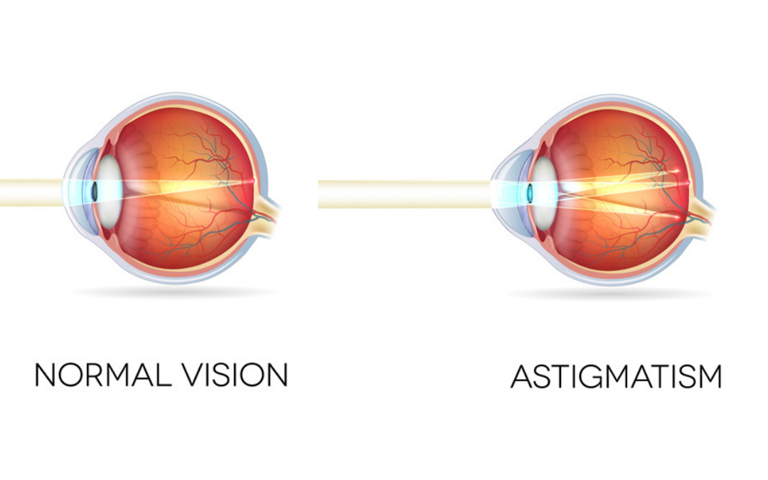 Astigmatism and the Way to Treat it