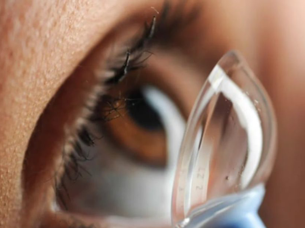 Achieving Clearer Vision with Hybrid Contact Lenses for Keratoconus Patients