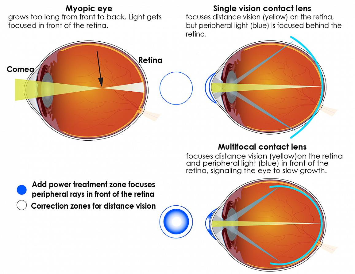 The center portion of the lens corrects nearsightedness so that distance vision is clear, and it focuses light directly on the retina. The outer portion of the lens adds focusing power to bring the peripheral light rays into focus in front of the retina. (Source: https://link.springer.com/article/10.1007/s40123-021-00394-7/figures/1)