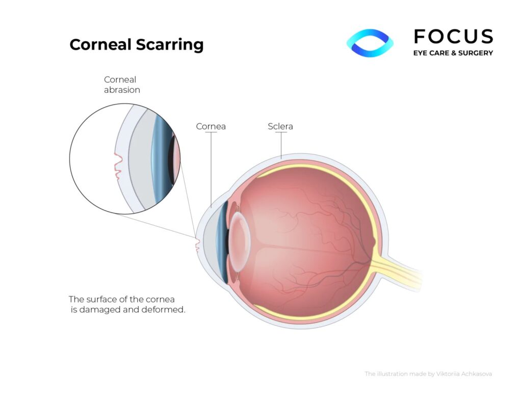 corneal scarring