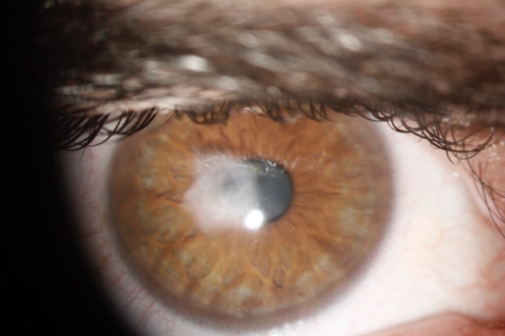 corneal scarring and impact