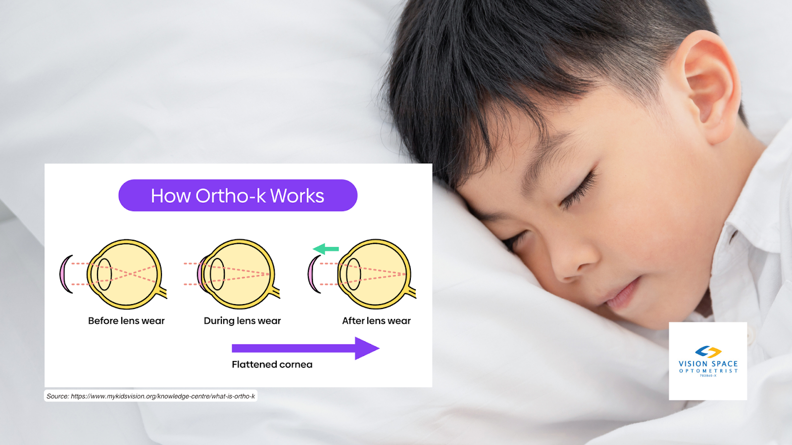  When the Ortho-K lenses are worn during sleep, they act to flatten the central cornea by redistributing the epithelial cells, which are the outermost cells of the cornea. [Image Source: https://www.mykidsvision.org/knowledge-centre/what-is-ortho-k.]