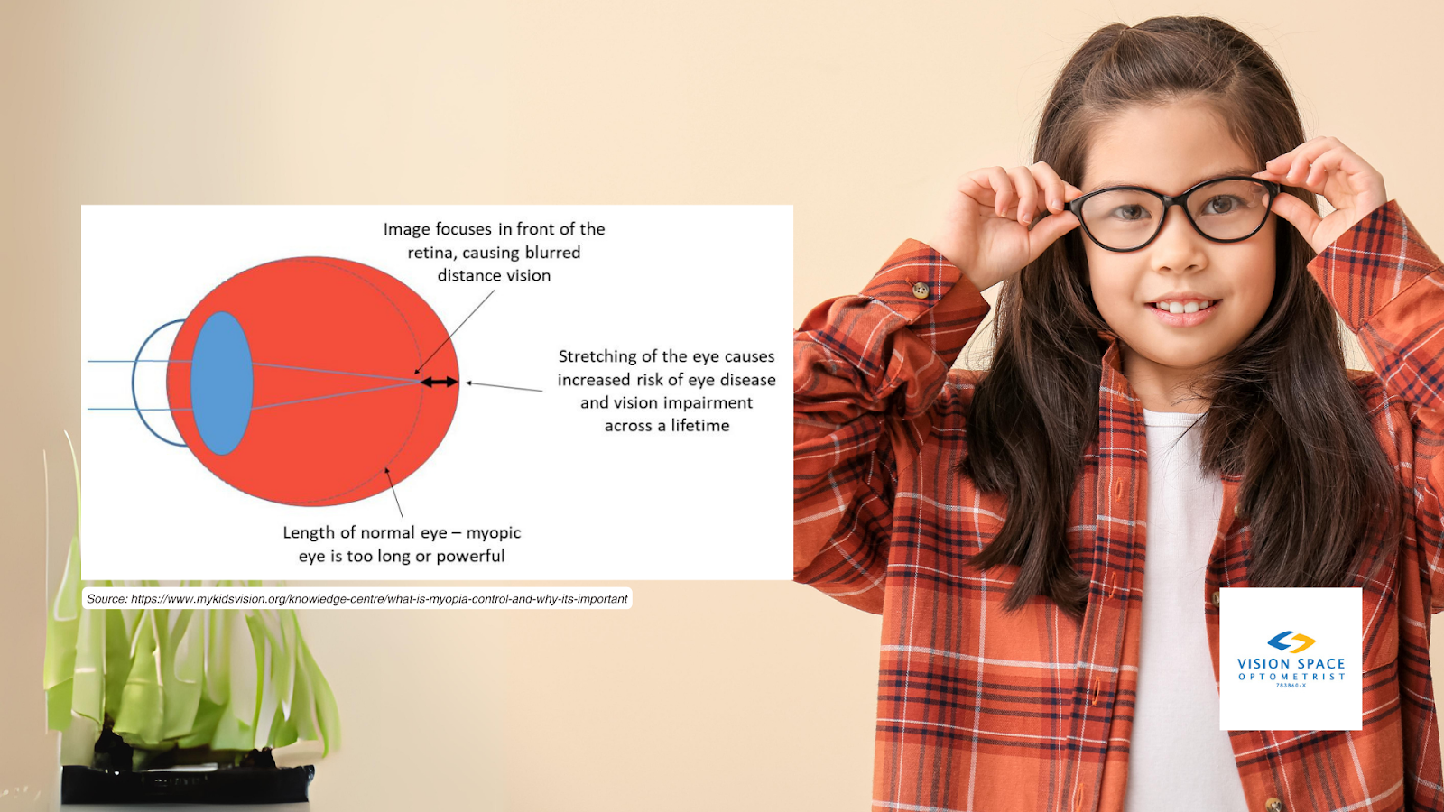 A myopic eye is longer, or more stretched, than a normally sighted eye due to excessive eye growth. [Image Source: https://www.mykidsvision.org/knowledge-centre/what-is-myopia-control-and-why-its-important.]