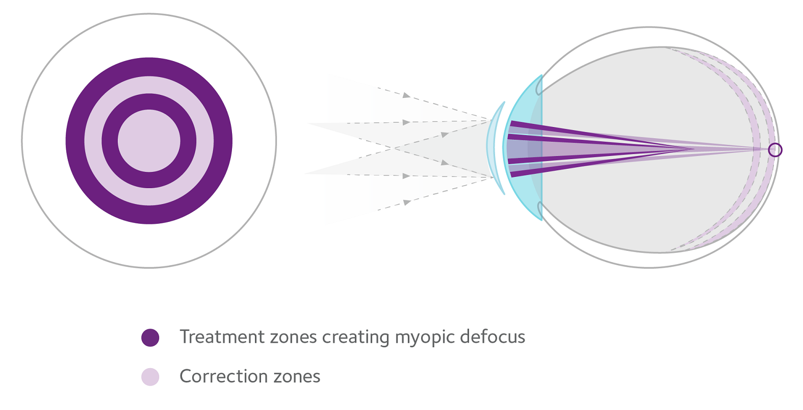 Two treatment zones create myopic defocus with image focus in front of the retina, rather than behind it to slow axial elongation. Two correction zones correct myopia in all gaze positions (Source: https://www.myopiaprofile.com/articles/mastering-misight)