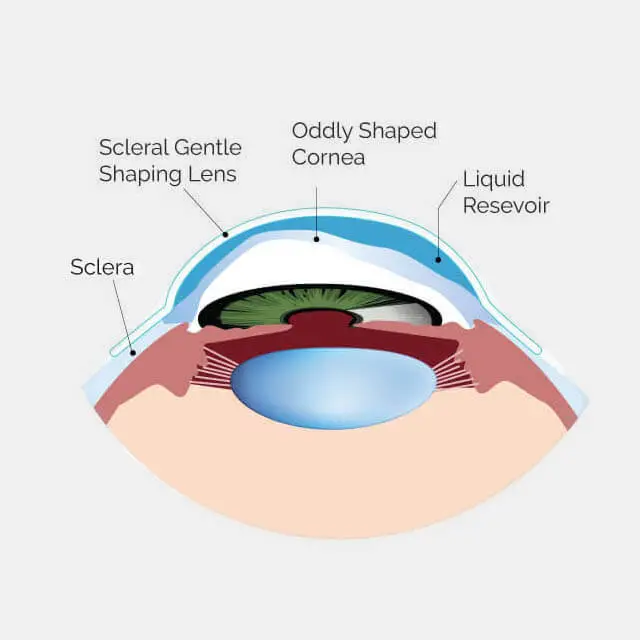 A Scleral lens vaults over the entire cornea. (Source: https://www.theeyecenteratjackson.com/eye-care-services/scleral-lenses-optometrist/)