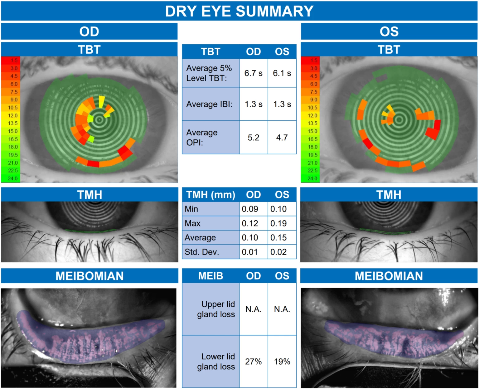 Infrared technology also allows the MYAH to image the oil glands along the top and bottom lids called Meibomian glands. (Source: https://komokaoptometry.com/myah-a-powerful-tool-for-dry-eye-and-myopia-management/)