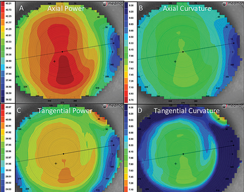 The four basic power maps of corneal topography. (Source: https://www.reviewofoptometry.com/article/ro0817-mapping-out-corneal-topography)