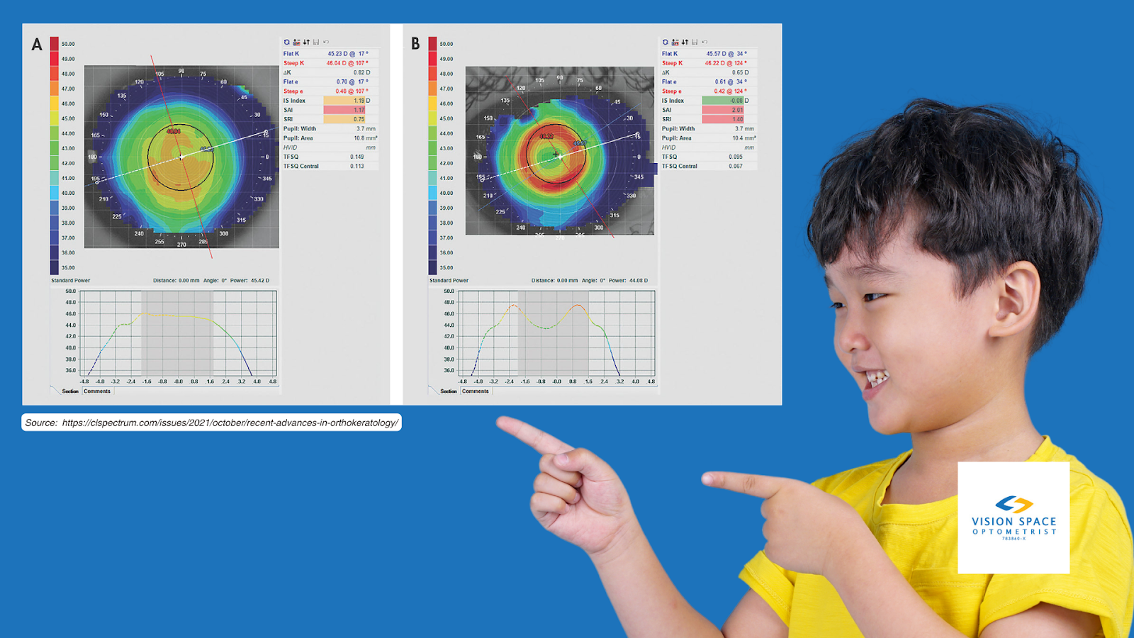 Modern ortho-k lens designs allow for fast and predictable treatment. (A) Topography of a young myopic astigmatic patient before treatment and (B) after 20 minutes of wear. [Image Source: https://clspectrum.com/issues/2021/october/recent-advances-in-orthokeratology/.]