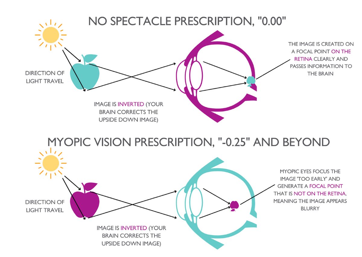 mild myopia -0.25 to -3.00