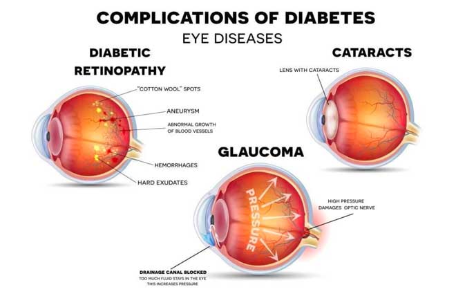 eye complications of diabetes