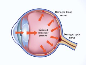 intraocular pressure measurement